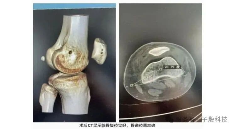 术后CT显示髌骨复位良好,骨道位置准确